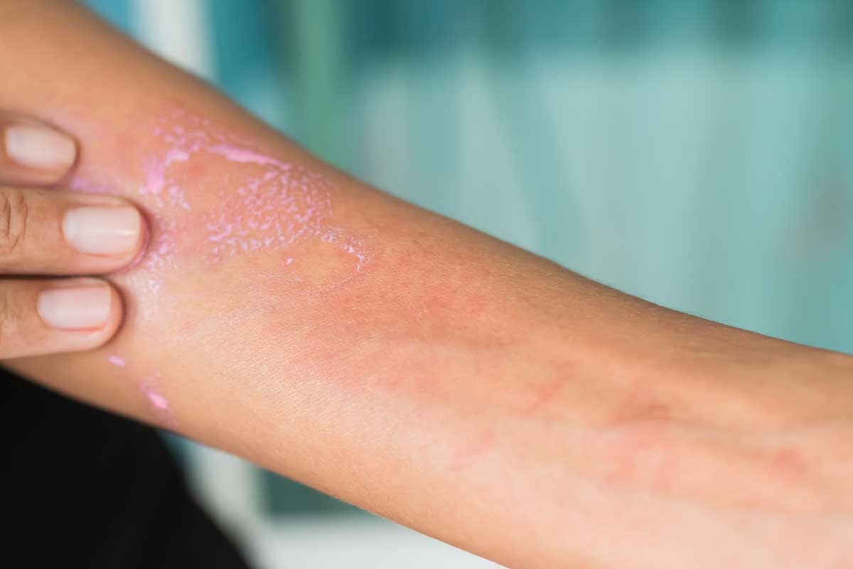 蕁麻疹會自己好嗎