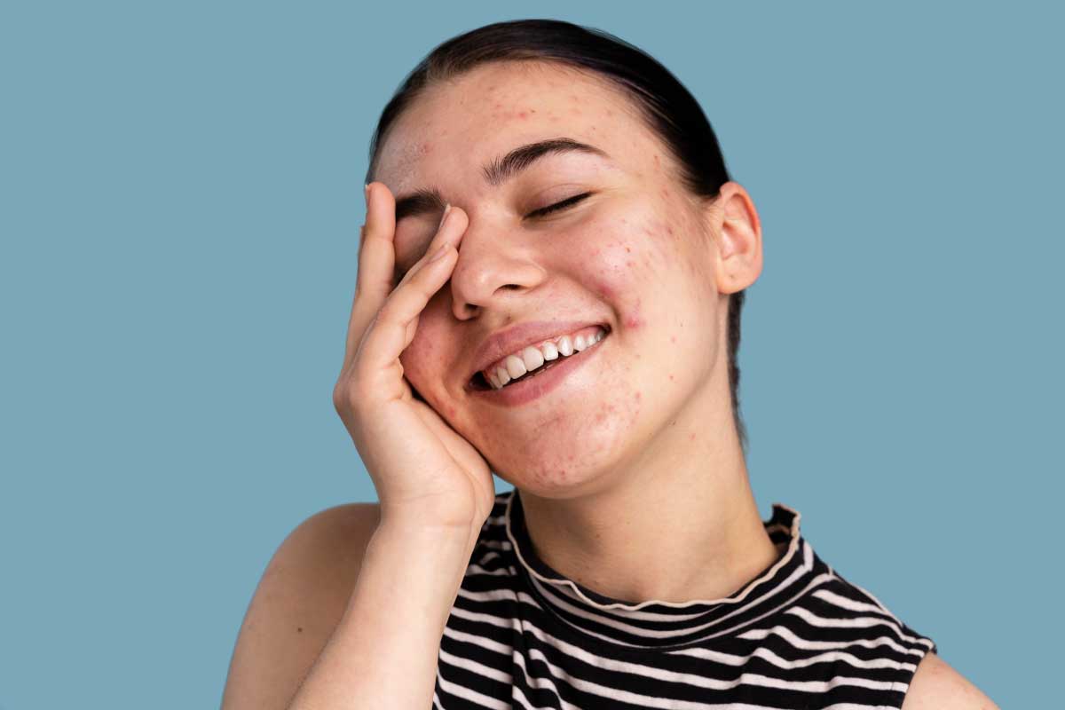 下巴囊腫型痘痘