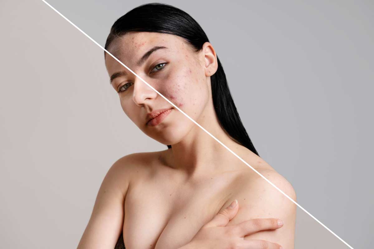 囊腫型痘痘破掉